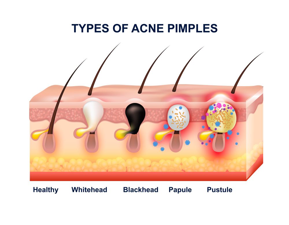 Skin Acne Anatomy Composition. Colored skin acne anatomy composition with types of acne pimples before and after vector illustration