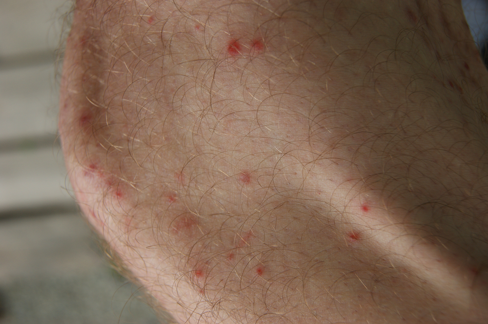 Leg of the person with skin coated red spot rash. Skin of the person on leg coverring rash