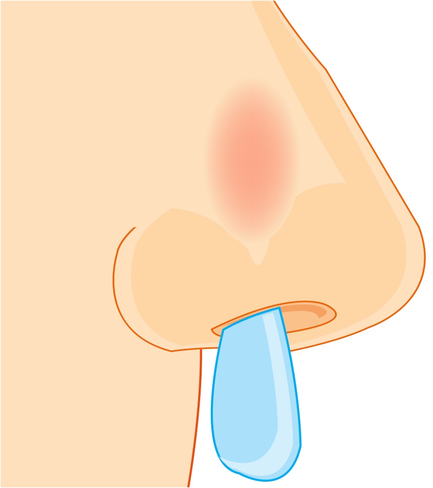 Affected by cold nose of the person on white background is insulated. Vector illustration of the nose of the person sick with a cold