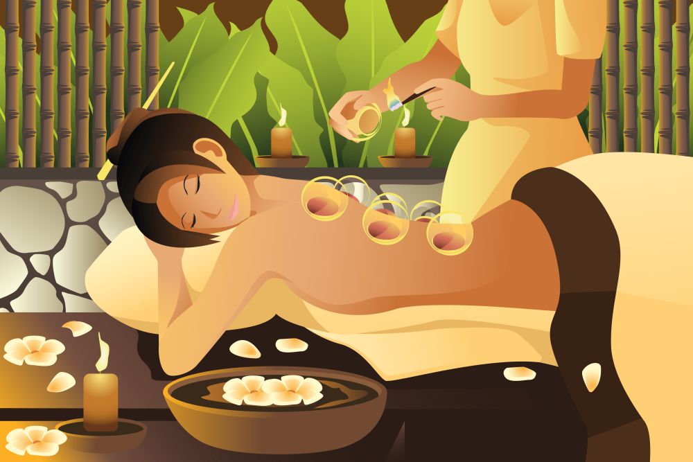 A vector illustration of woman receiving a cupping treatment