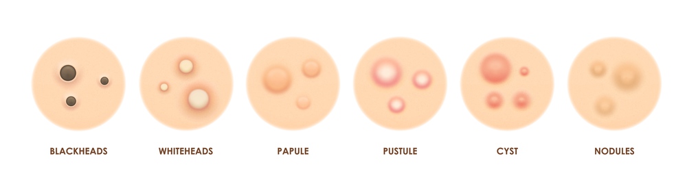 Body skin acne types, pimples and papules, pore inflammation and problems, vector icons. Face skin acne types, blackhead, pustule or whitehead, papule and cyst with nodules for skincare cosmetology. Body skin acne types, pimples, pore inflammation