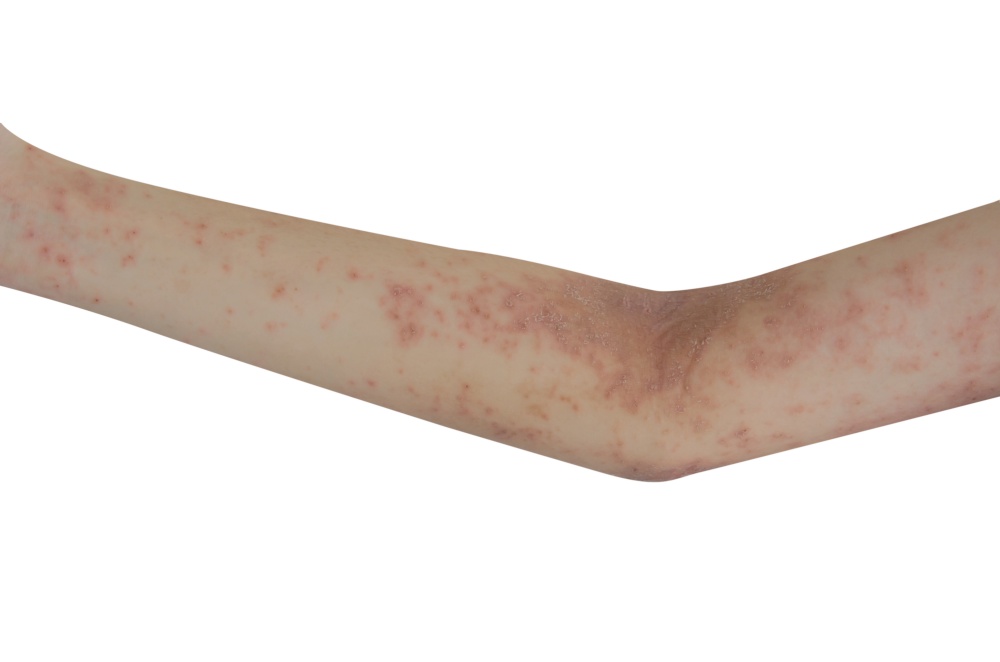 Skin rash on the arms isolated a white background. health care concept