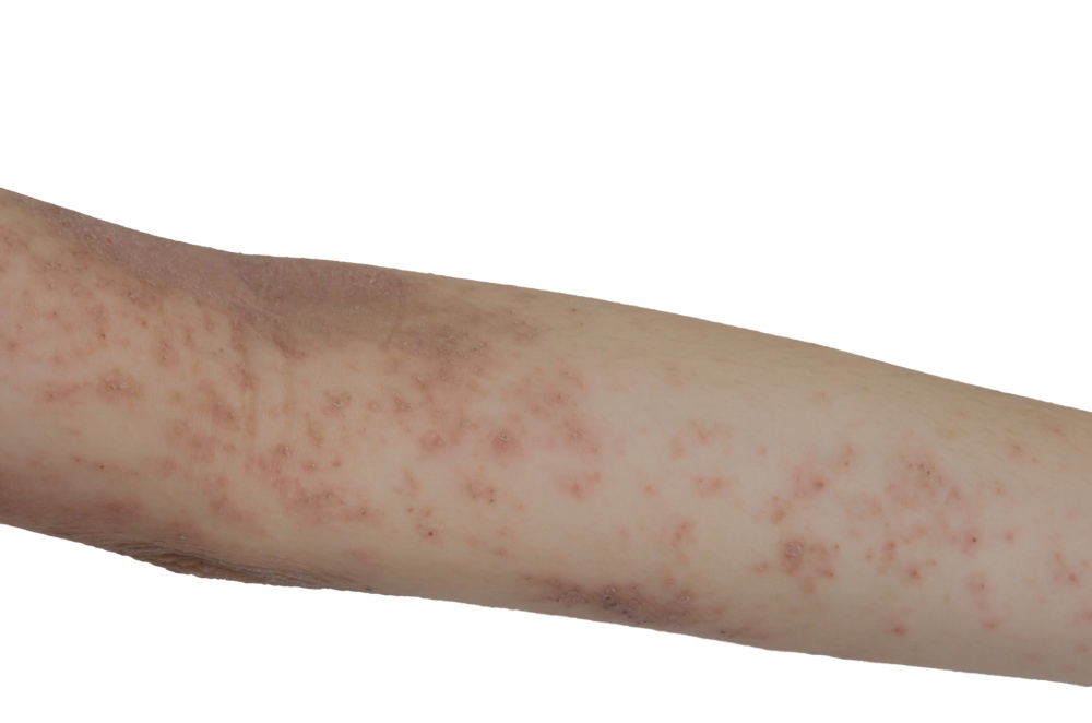 Skin rash on the arms isolated a white background.