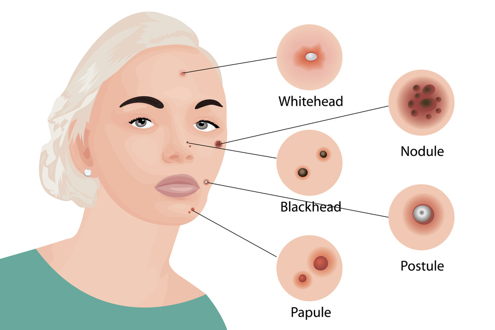 Acne types on a face vector illustration. Cosmetology skincare, skin treatment