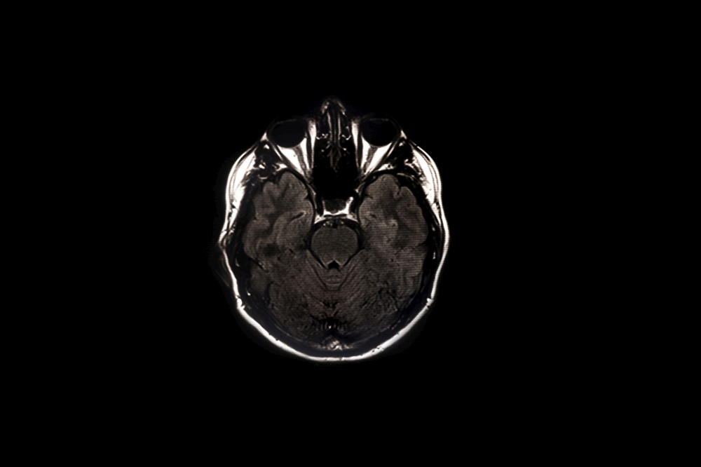 Brain scan, imaging of the brain on x-ray