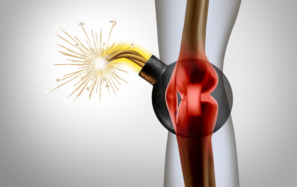 Painful knee pain and painful joint as a medical illustration of a human skeleton showing a sports injury or a physical accident as a physical damage time bomb with 3D illustration elements.