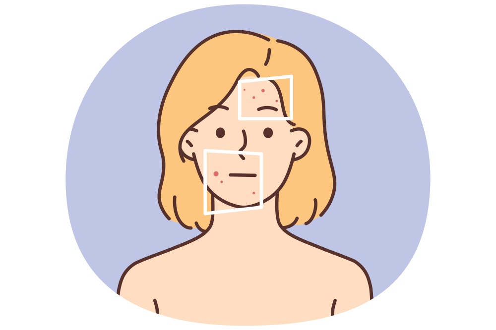 Naked woman with red pimples on face suffer from dermatitis. Unhappy female with redness or allergy struggle with facial problem. Skincare. Vector illustration.. Woman with red pimples on face