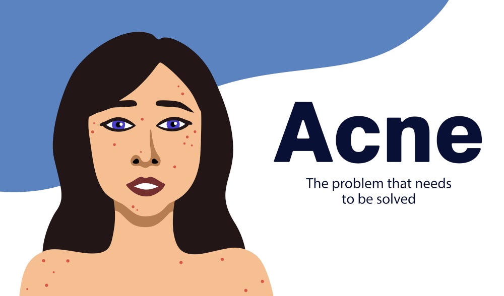 Banner about acne with a young fair skinned woman, minimalistic illustration, naked to the shoulders. Banner about acne with young fair skinned woman minimalistic illustration naked to shoulders