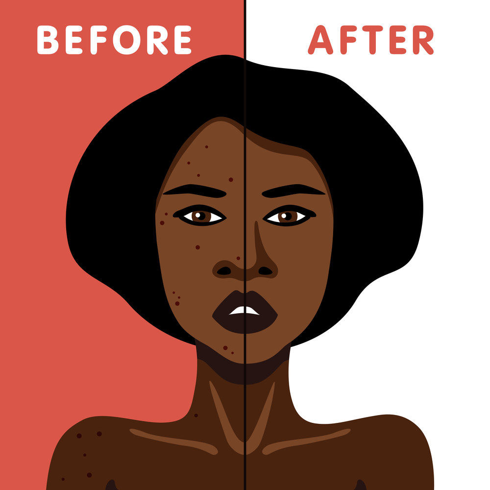 Vector image of an African American woman before and after acne skin treatment minimalistic illustration. Vector image of African American woman before and after acne skin treatment